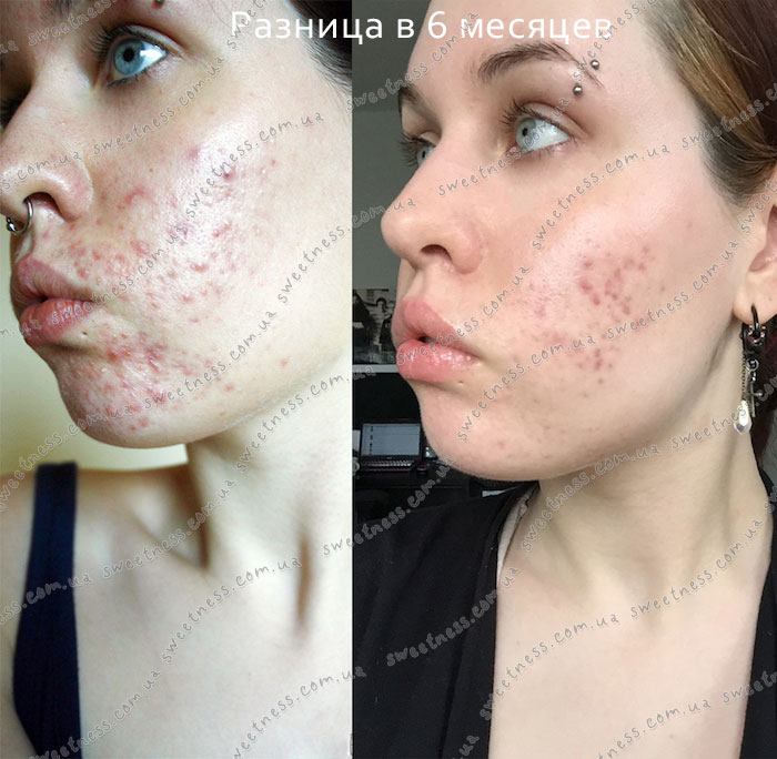 COSRX Natural BHA Skin Returning A-Sol Тонер с BHA кислотами, фото 6 | Sweetness