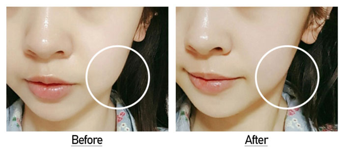 Medi-Peel Perfect Cooling Skin Face Type Охлаждающий массажер для лица фото 6 / Sweetness